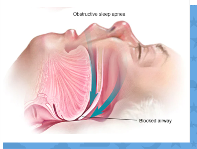 sleep apnea diagram